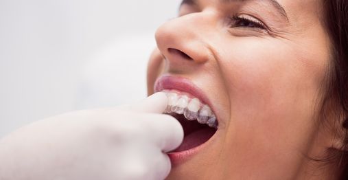 Can I Switch from Braces to Invisalign? The Complete Guide