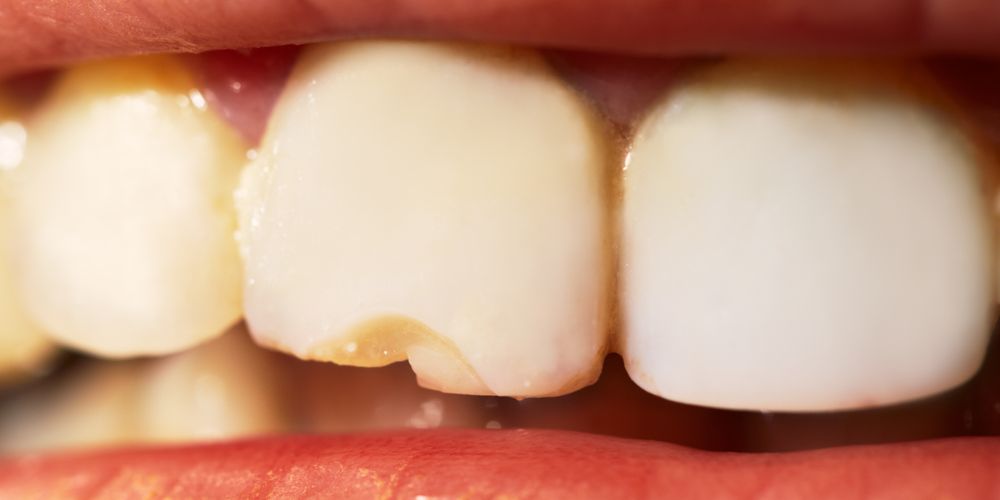 Can Invisalign Chip or Crack Your Teeth?