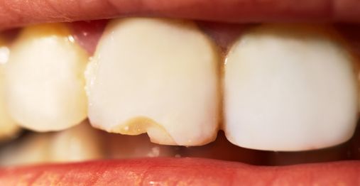 Can Invisalign Chip or Crack Your Teeth?