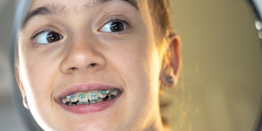 Can You Wear Wax on Braces While Sleeping?